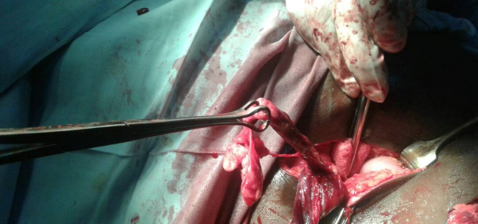 Case report : perforated appendix within a right inguinal hernia sac (Amyand’s hernia)