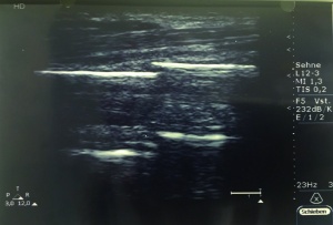 Figure 2. Ultrasound image of the right forearm demonstrating the fracture of the radial shaft