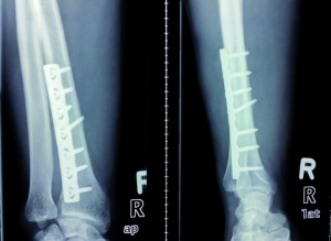 Figure 4. Radiograph of the right forearm in two planes at three-month follow-up